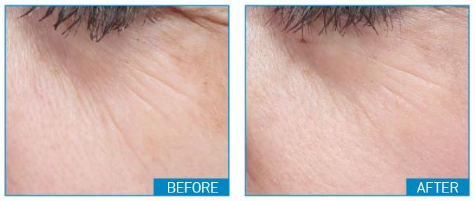 anp moisture lock review