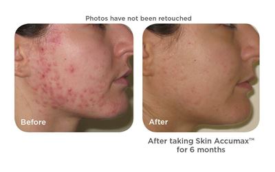 skin accumax before and after