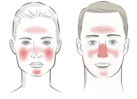 faces of rosacea