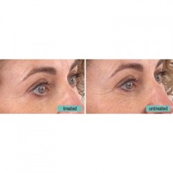 Remescar Crow's Feet 8ml